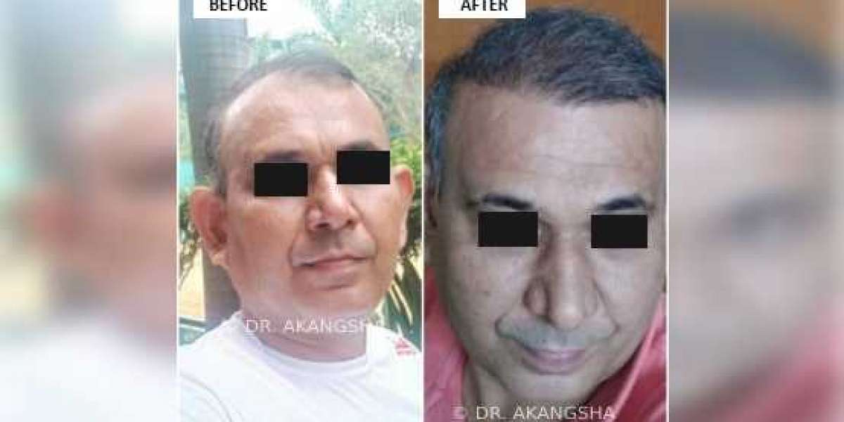 Avail the Benefits of Hair Transplant to Restore Baldness