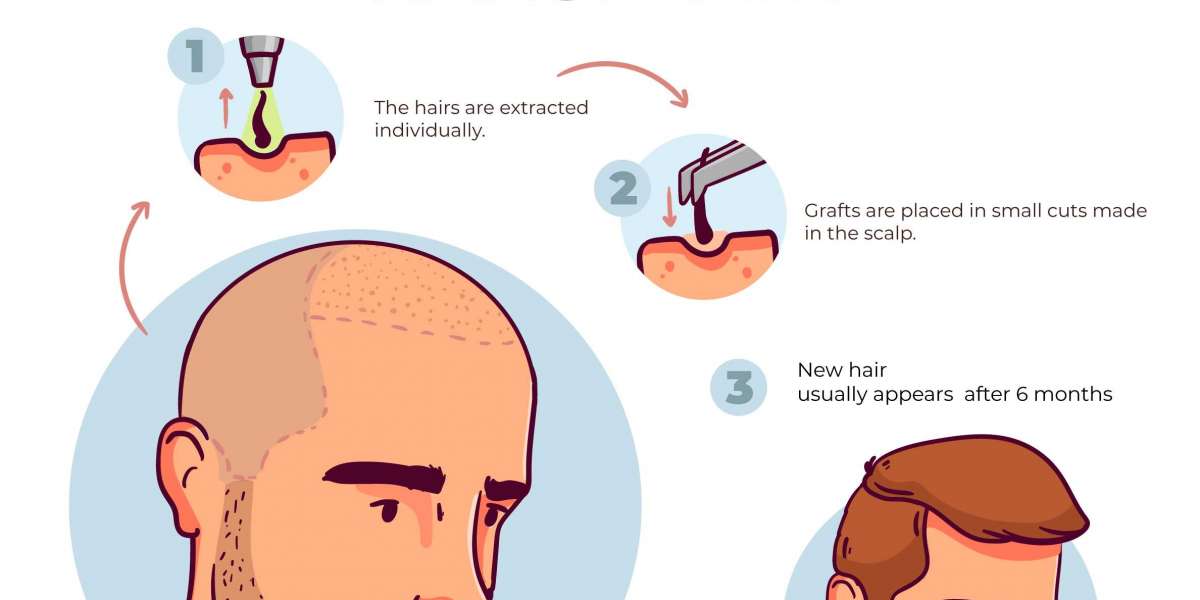 Cost of hair transplant in Hyderabad