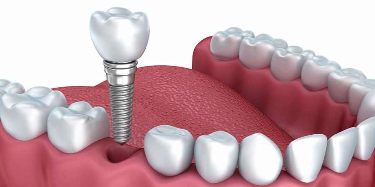 The Process of Dental Implant Placement