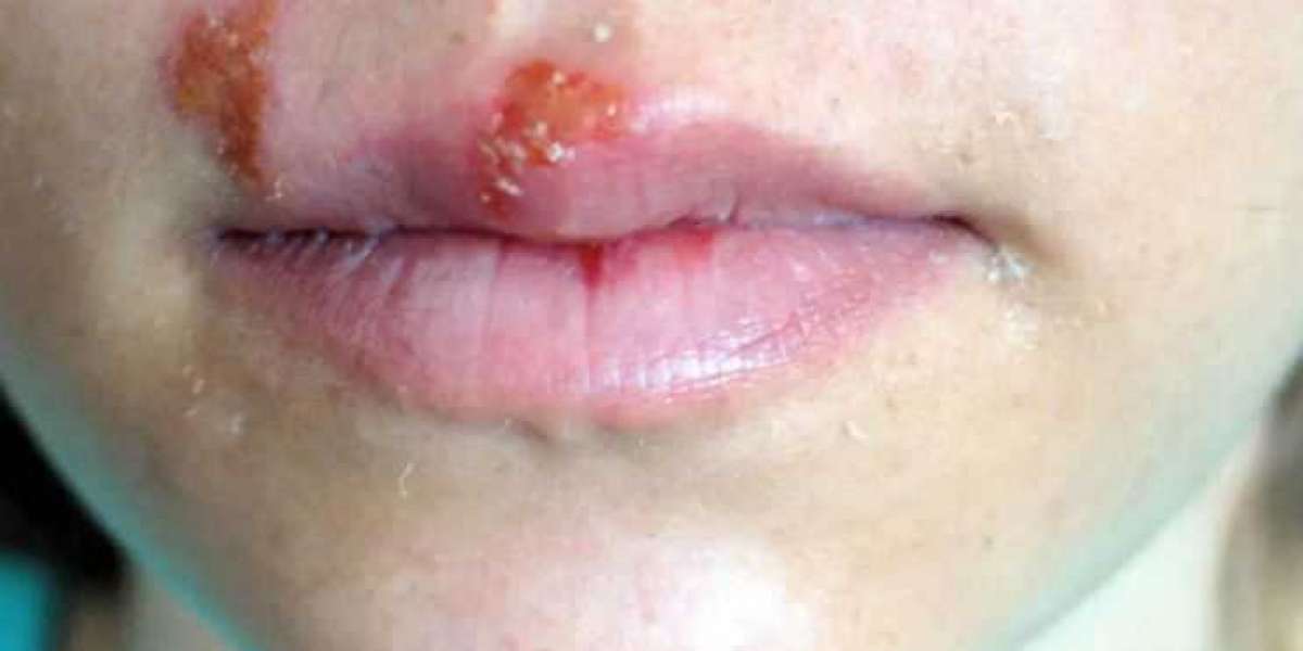 Herpes Cure - The Best Herpes Supplement for Effective Relief: