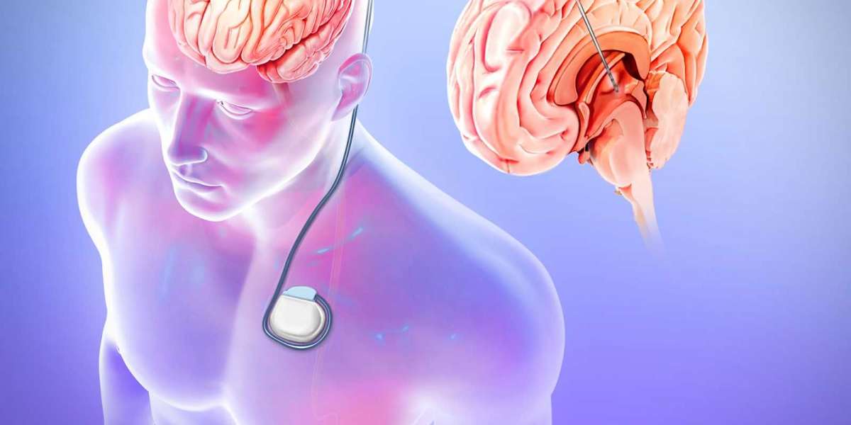 Global Epilepsy Surgery Market Insights on Industry Size, Share & Growth