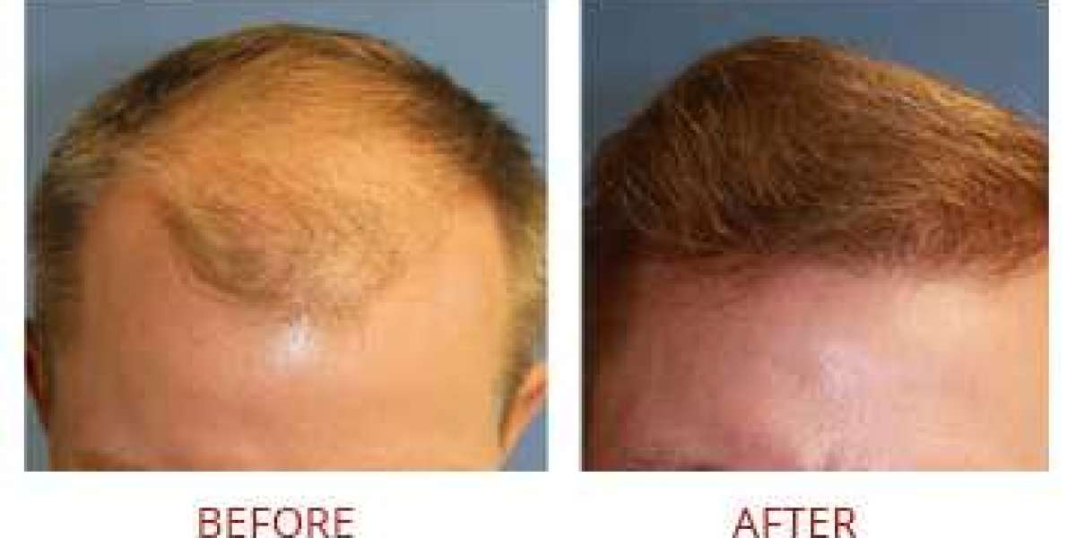 Witness Amazing Results: FUE Hair Transplant Before and After