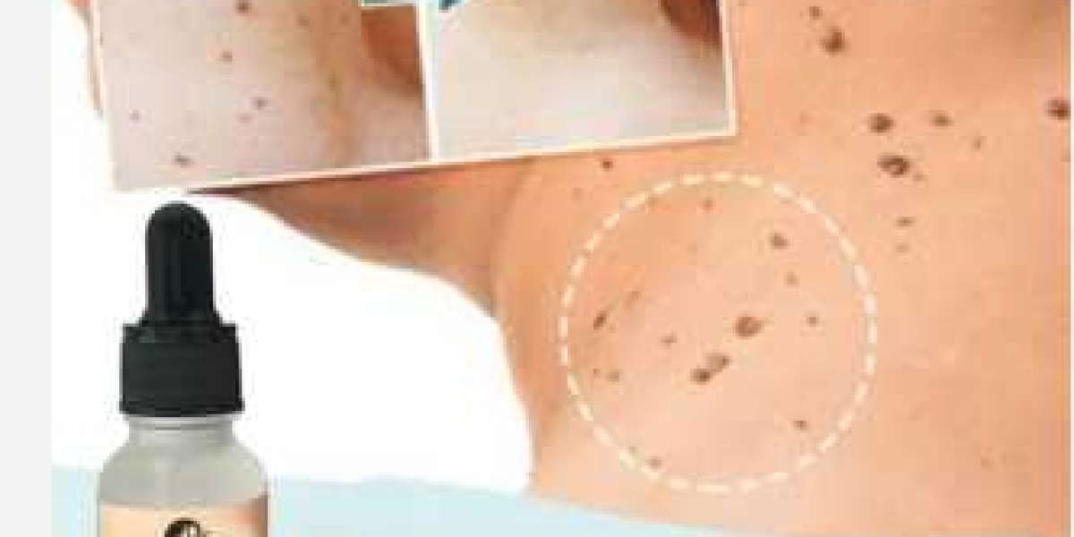 Essence Skin Tag Remover How Do I Get Rid of Skin Tags?: Does It Work!