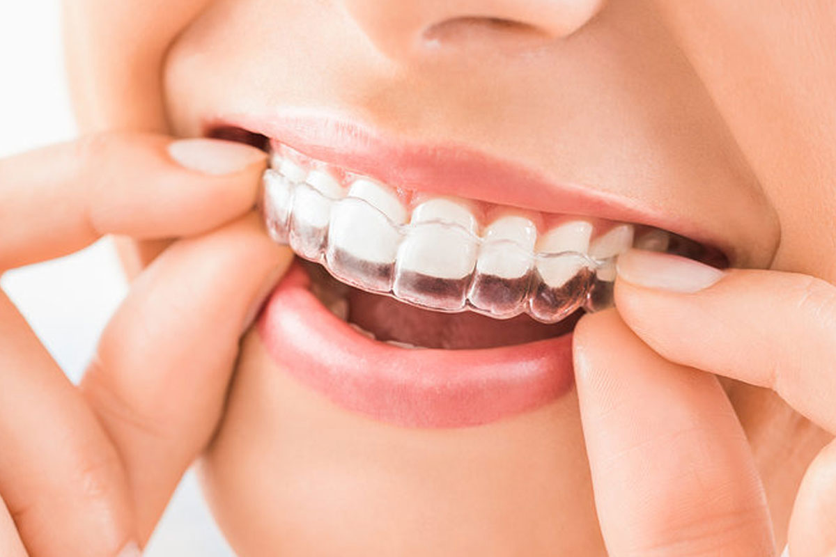 Understanding the Components of Invisible Braces