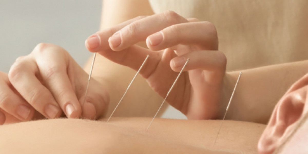 Acupuncture Treatment and Cupping Therapy