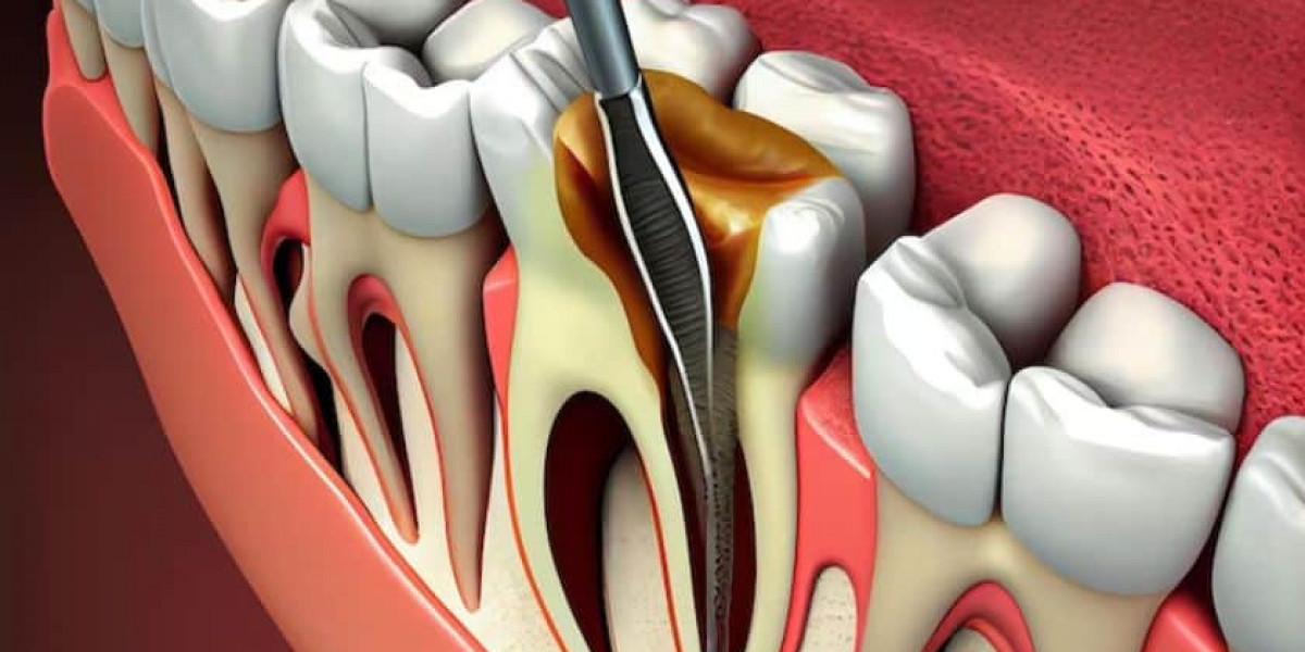 Root Canal: What Is It, Diagnosis, Treatment and Cost