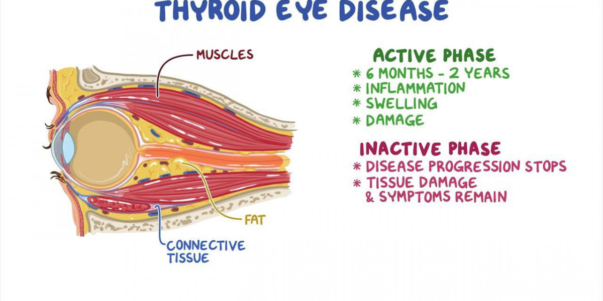 Navigating the Challenges of Thyroid Eye Disease: A Comprehensive Guide