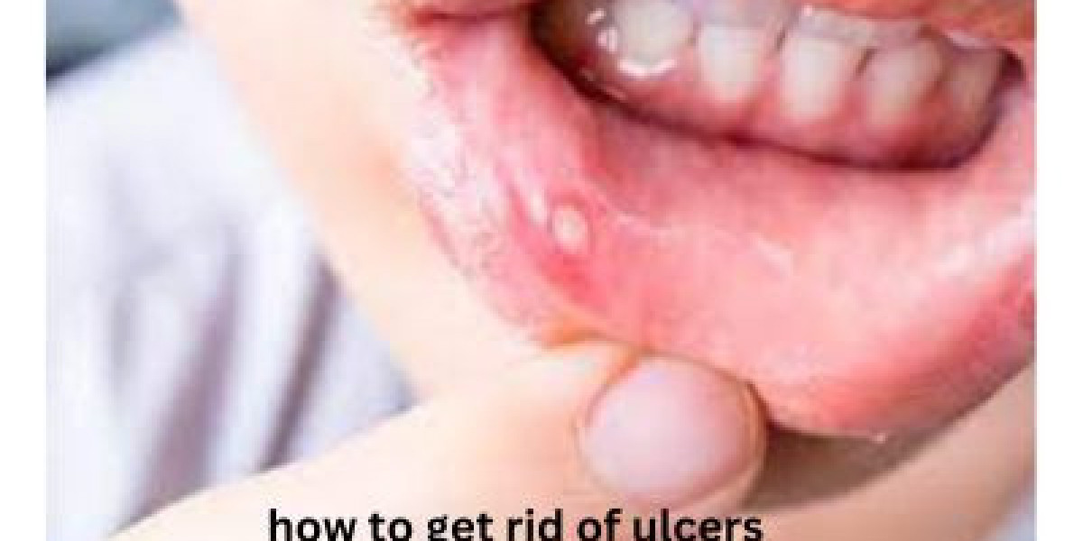 Soothing Solutions: How to Get Rid of Ulcers Naturally