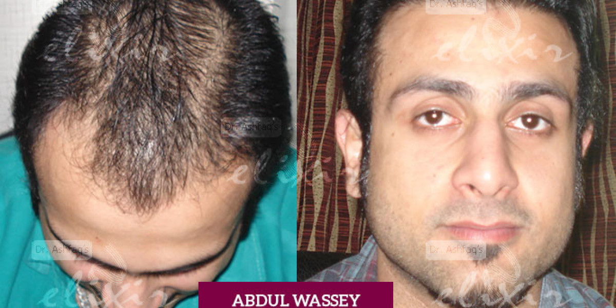 What is The Best Hair Restoration Treatment?