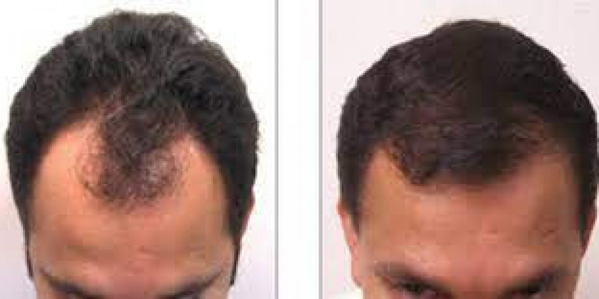 Hair Restoration Dubai UAE