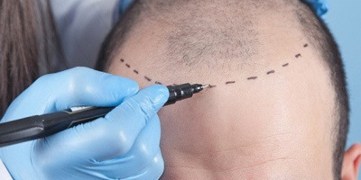 Unlocking Confidence: A Comprehensive Guide to Hair Transplantation
