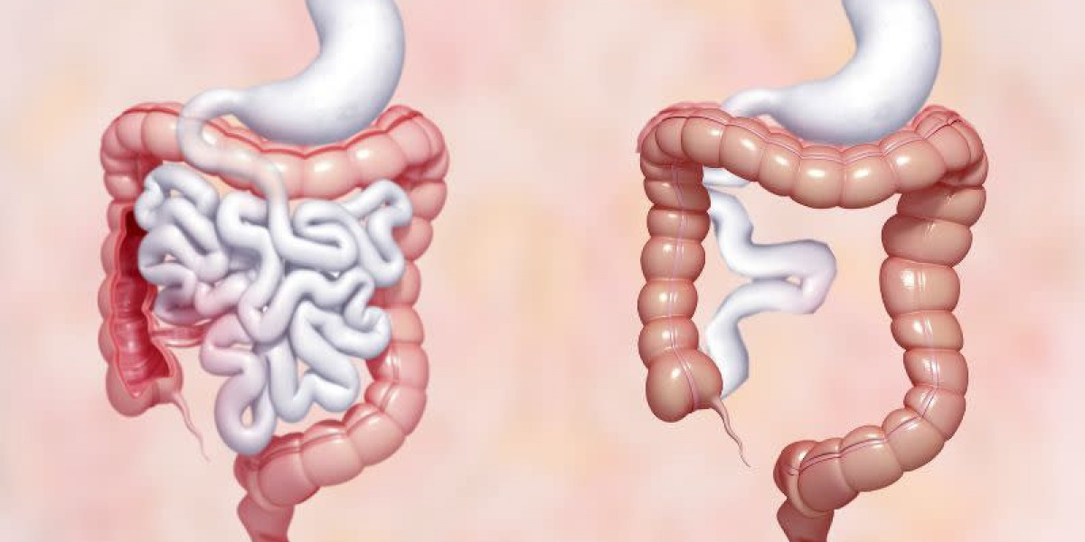 Short Bowel Syndrome Market Report: Epidemiology, Industry Trends, Share, Size, Demand (2024-2034)