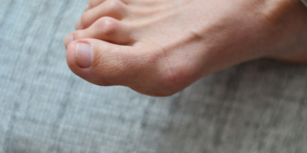 Big Toe Pain? Don’t Ignore It: A Guide to Bunions and Their Management