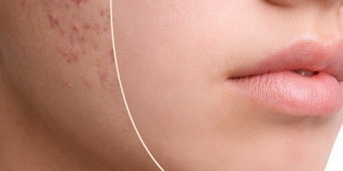 A Comprehensive Guide to Acne Scar Treatment in Islamabad