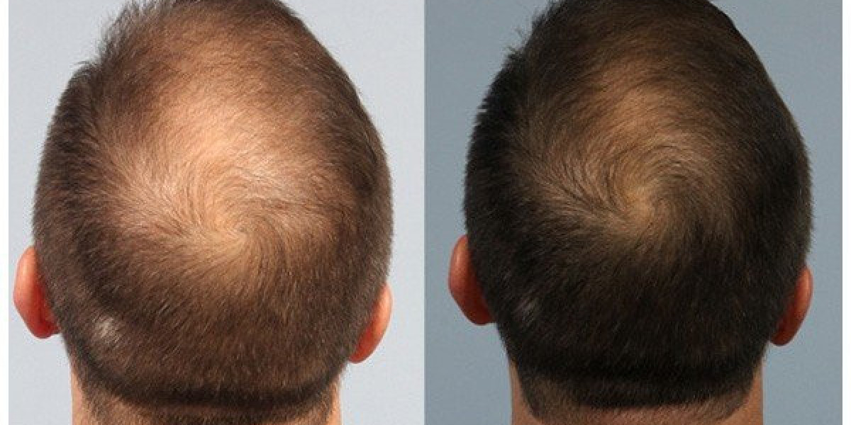 Combining PRP with Hair Transplantation: Maximizing Results