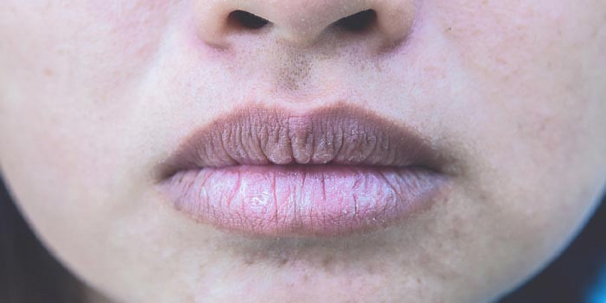 Combatting Smoker’s Lips: Effective Treatment Strategies