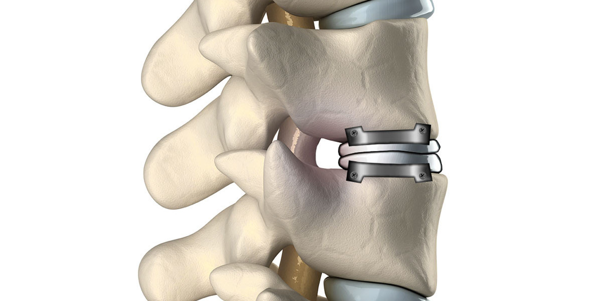 Cervical Total Disc Replacement Market Analysis, Business Development, Size, Share, Trends, Industry Analysis