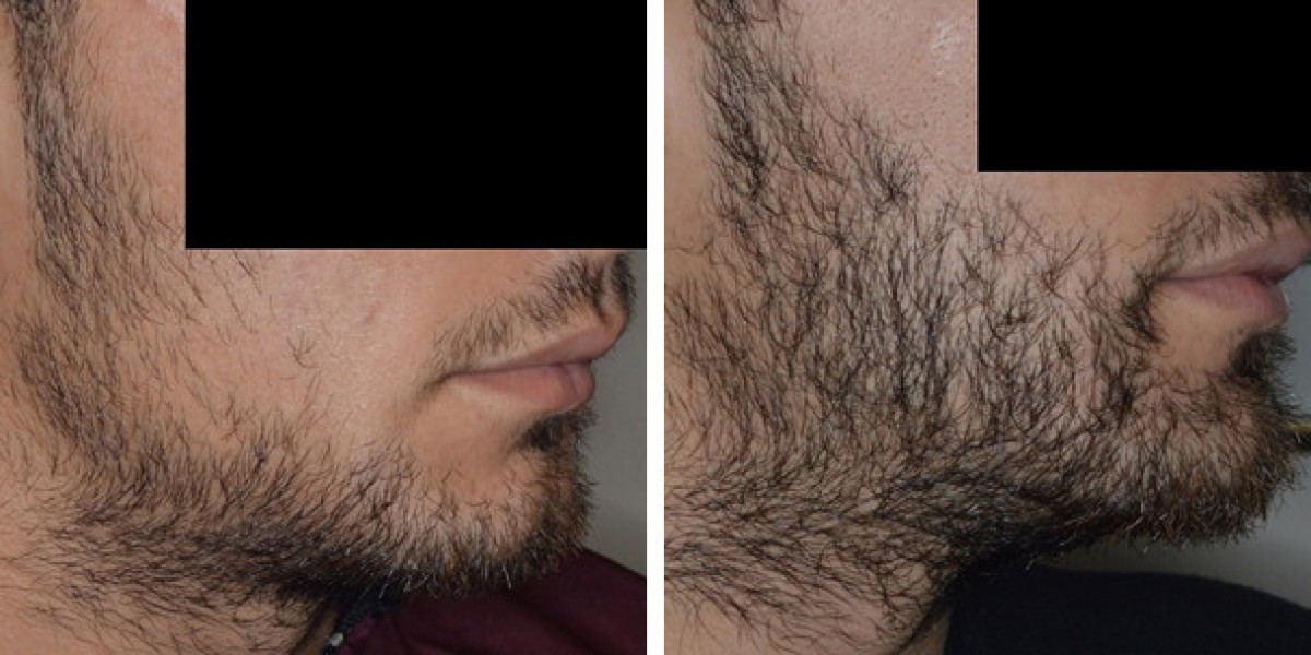 The Art of Facial Hair Transplant: Sculpting Confidence