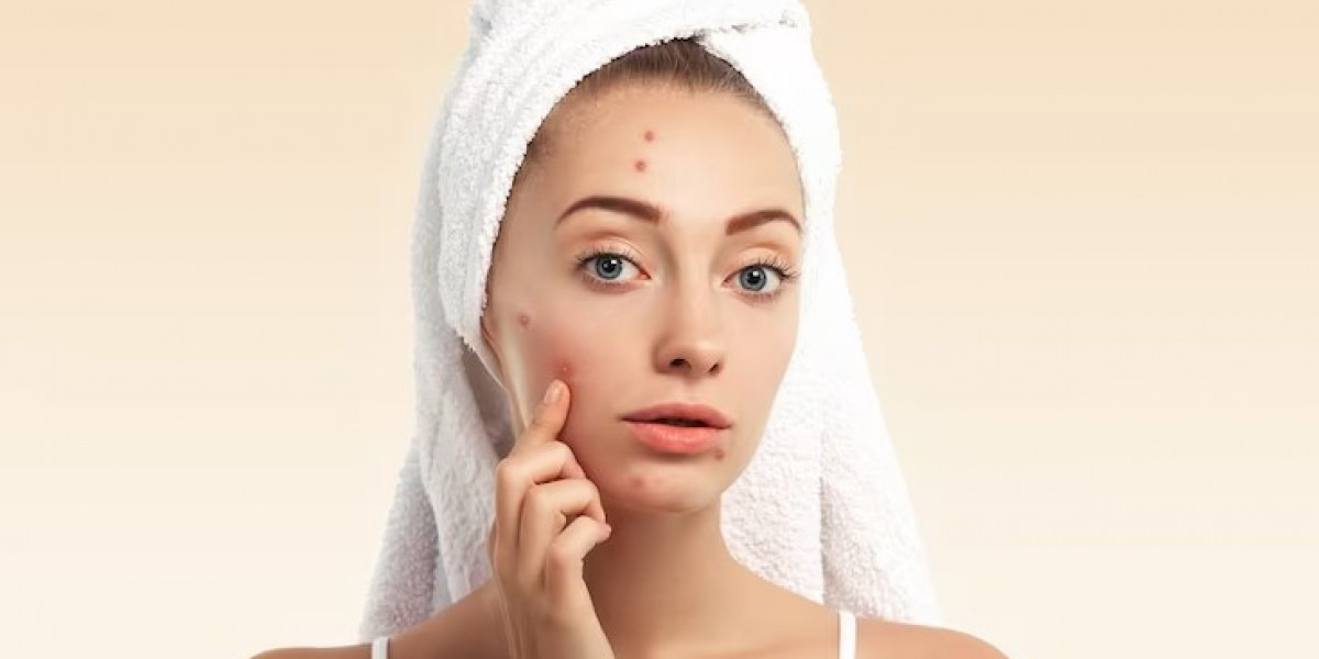 Comprehensive Strategies for Acne Scar Treatment: A Path to Clearer Skin