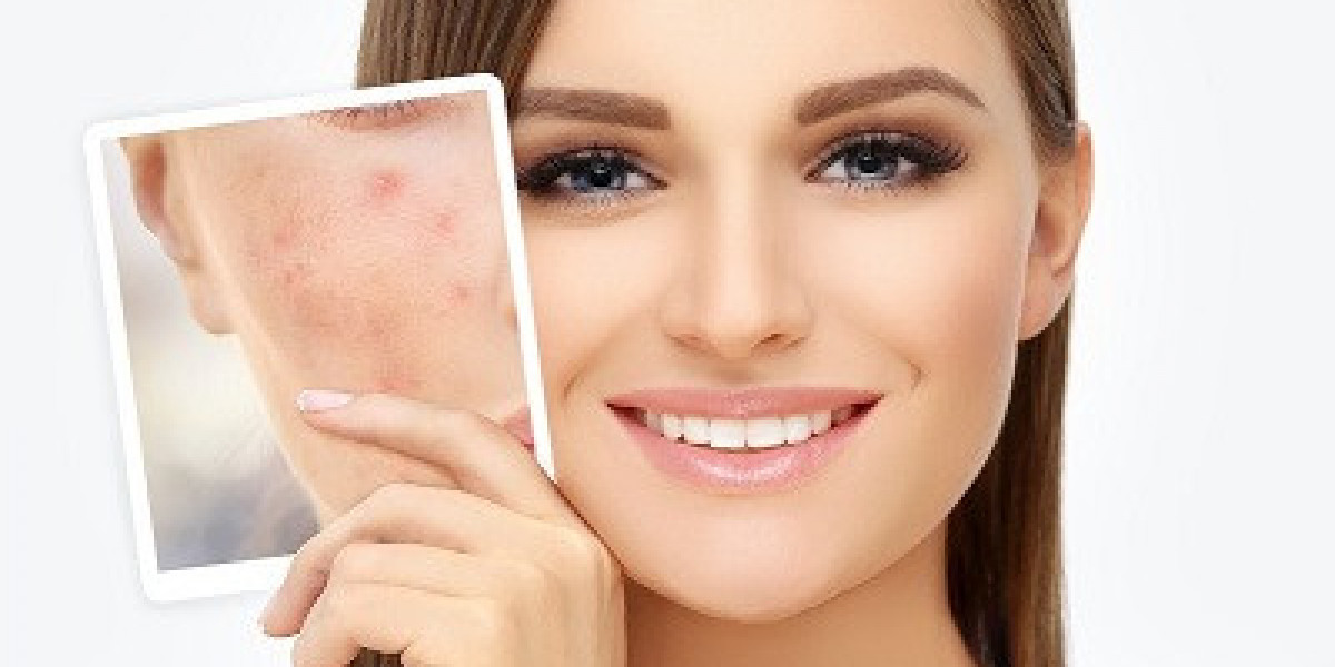 Unveiling Clearer Skin: A Comprehensive Guide to Acne Scar Treatments