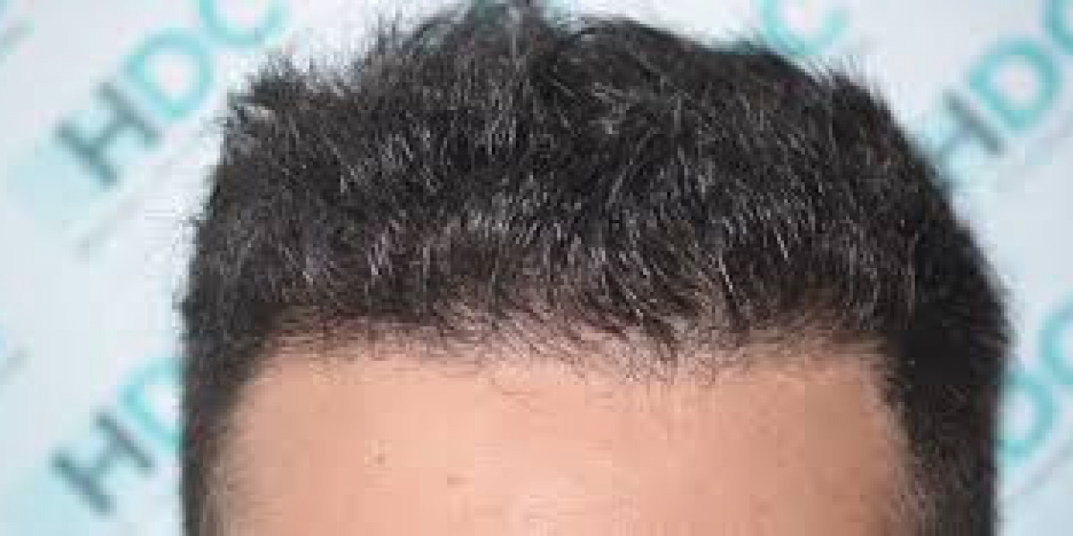 Hair Transplant Results of Curly Hair
