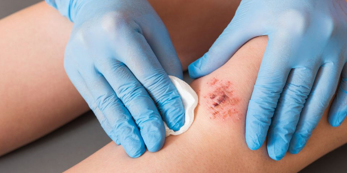 Japan Wound Care Market Growth Trends, Industry Demand, Analysis Report 2024-2032