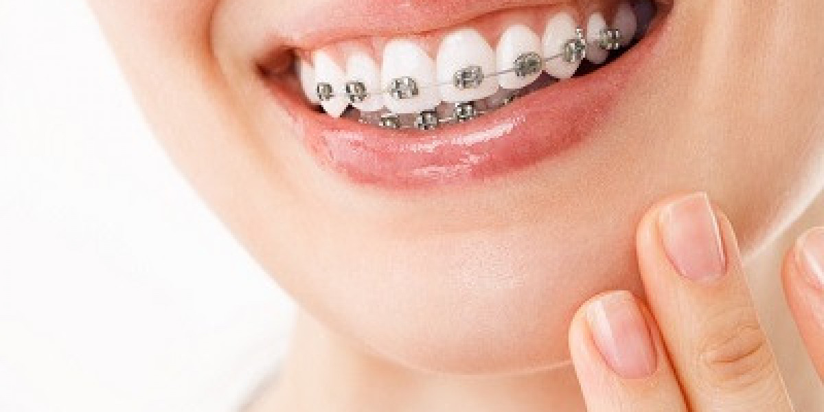 Smile Confidently: A Guide to Embracing Dental Braces