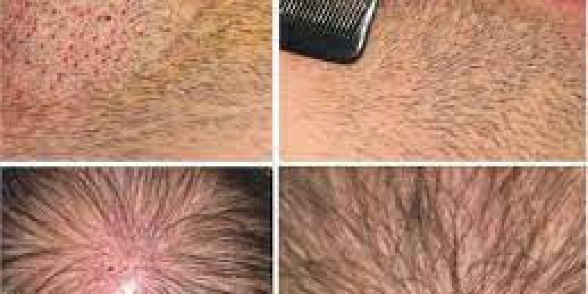 Affordable Direct Hair Transplant in Dubai