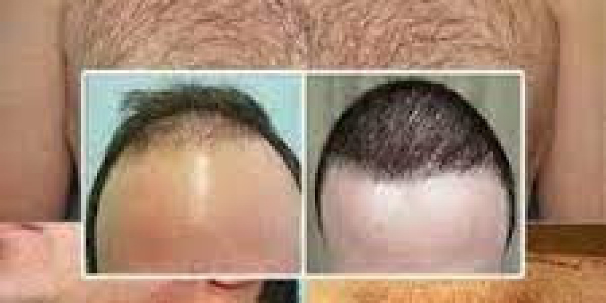 Maintain Good Scalp Hygiene: Hair Transplant Cost in Dubai