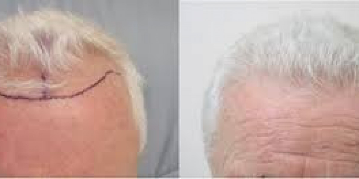 The Transformational Journey of FUE Hair Transplants for Older Men