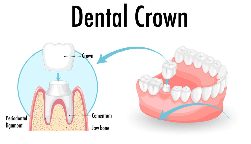 Expert Dentist Crown Services | Tooth Crown Surgery Specialists | All Cosmetic