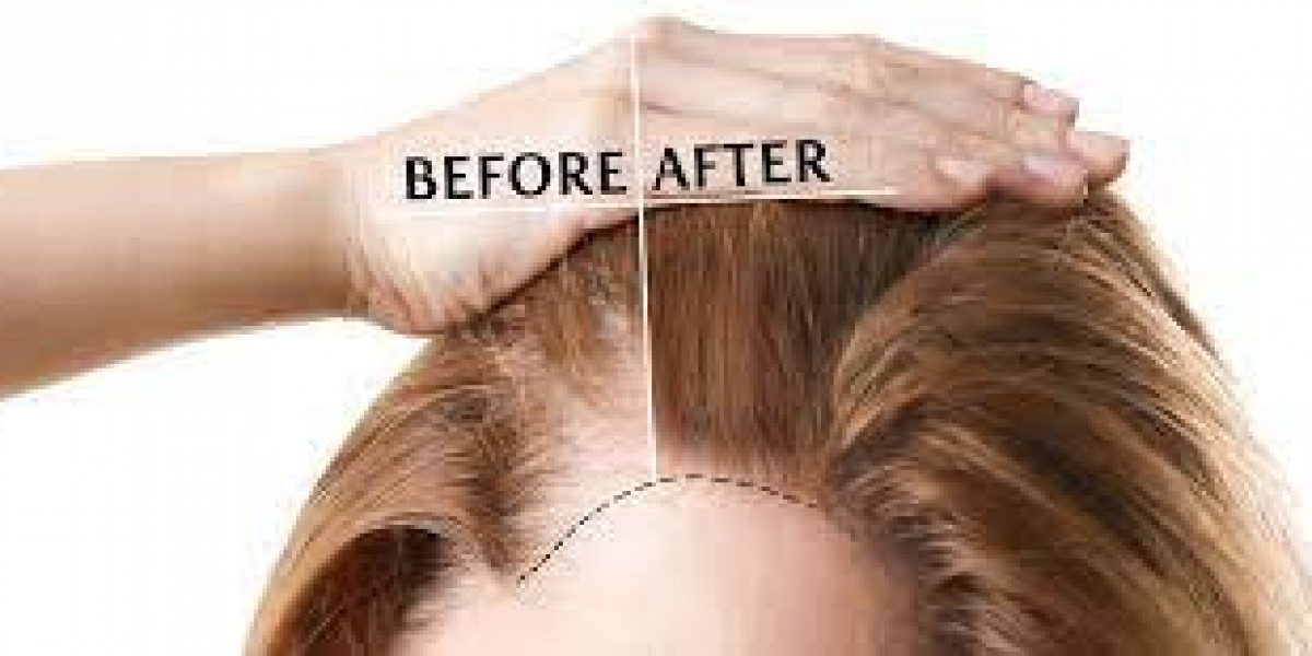 Demystifying Hair Transplantation: Your Questions Answered