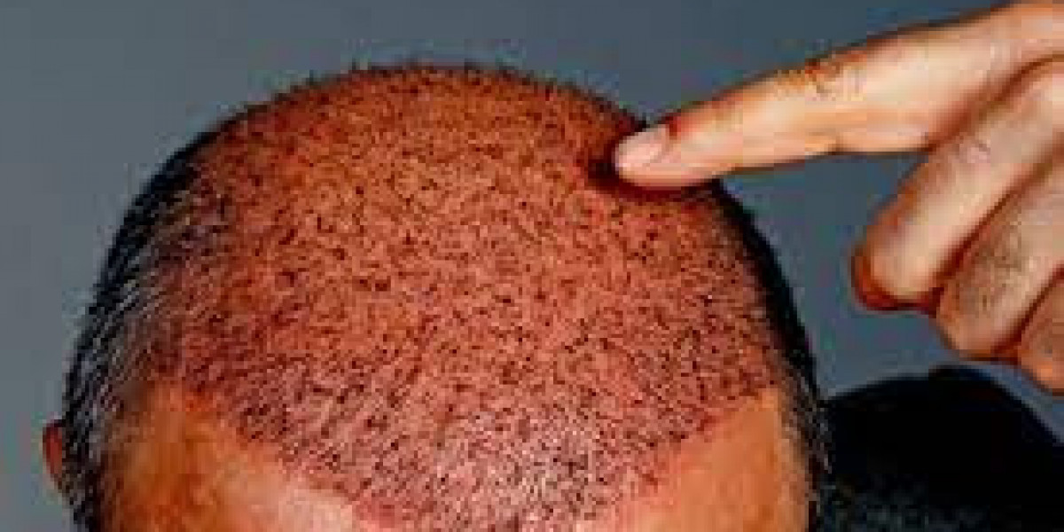 Discover the Secret to the Best Hair Transplant Results