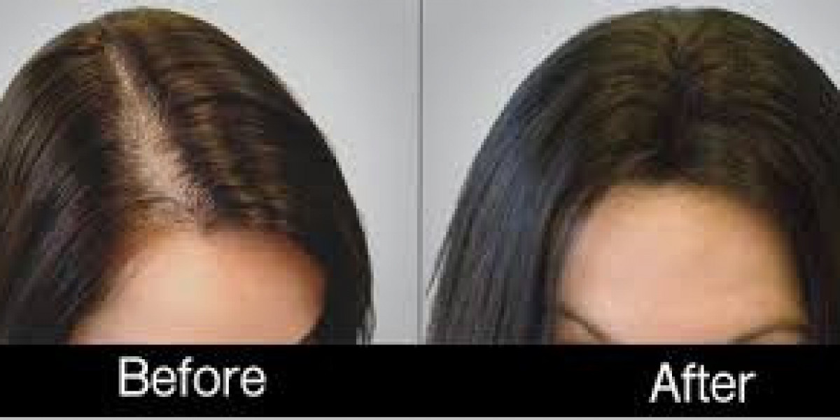 Women Hair Loss and Hair Transplant and Solutions