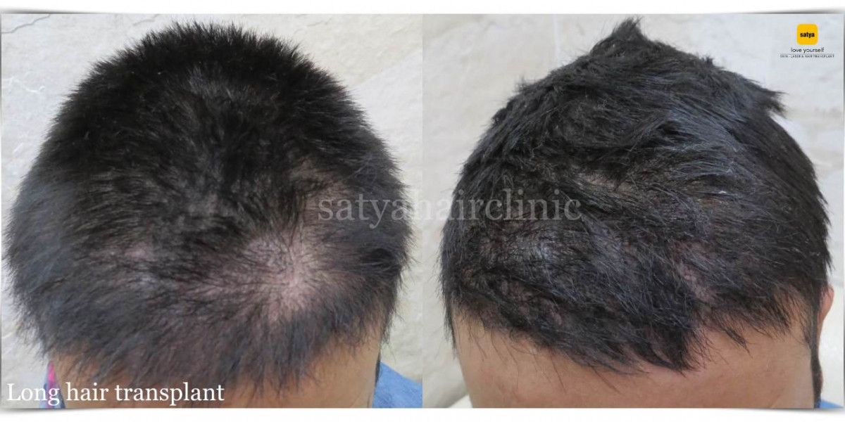 Your Premier Choice for Hair Transplants in Ahmedabad