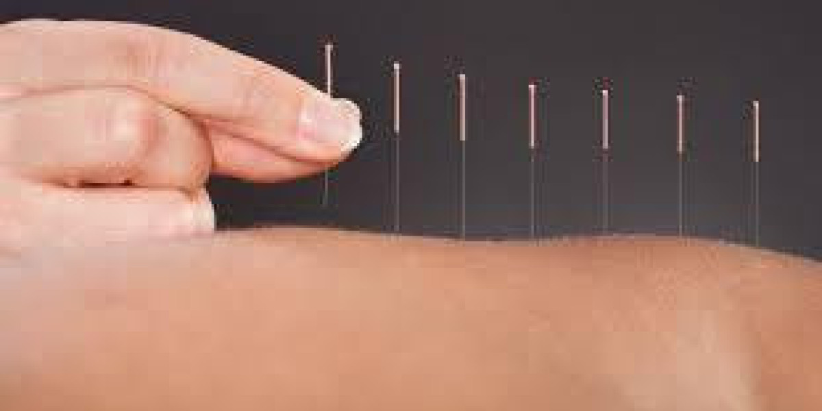 Acupuncture for Back Pain: A Drug-Free Solution for Lasting Relief