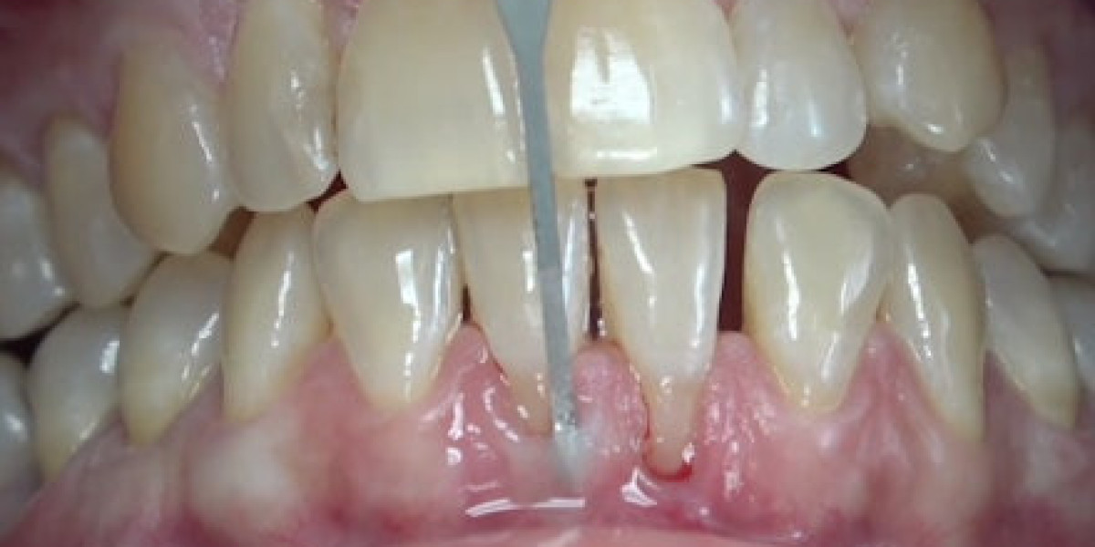 Mastering Gingival Grafting: The Role of 3D Printing in Modern Dentistry