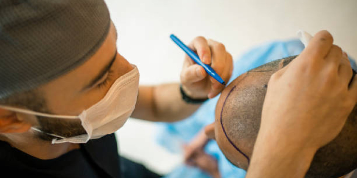 Hair Transplant in Dubai: Your Comprehensive Guide