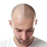 Hair Transplant In Islamabad