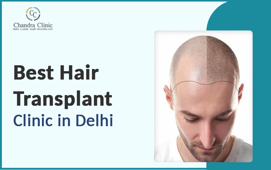 What’s the Average Cost of Hair Transplant Surgery in 2025? | by Chandra Clinic | Jan, 2025 | Medium