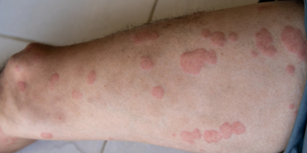 When Should You See a Doctor for Chronic Urticaria