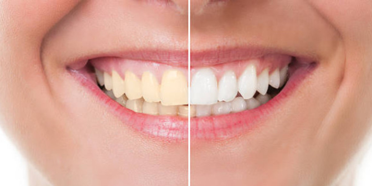 Boost Your Confidence with a Smile Makeover at a Dental Clinic Near You in Georgetown