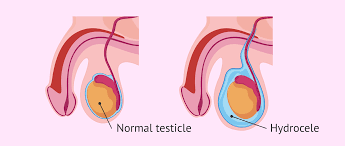 Hydrocele Surgery  - Shanti Madan Memorial Hospital