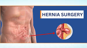 Hernioplasty Surgery - Shanti Madan Memorial Hospital