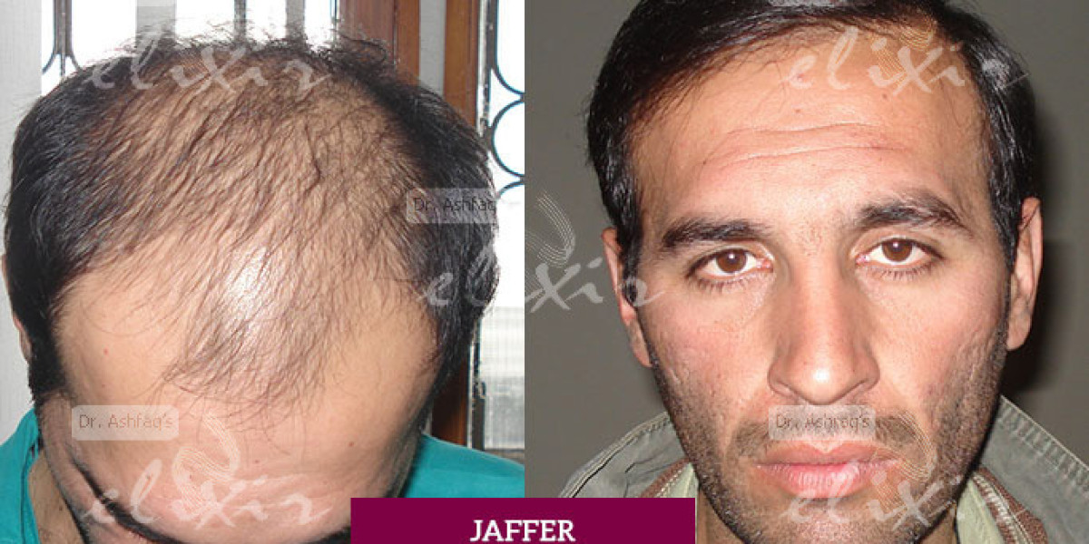 Hairline Timeline What to Expect After a Hair Transplant