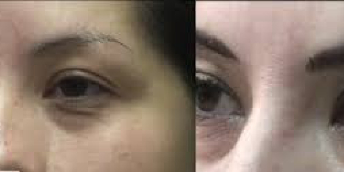 How Long Does an Eyebrow Transplant Last?