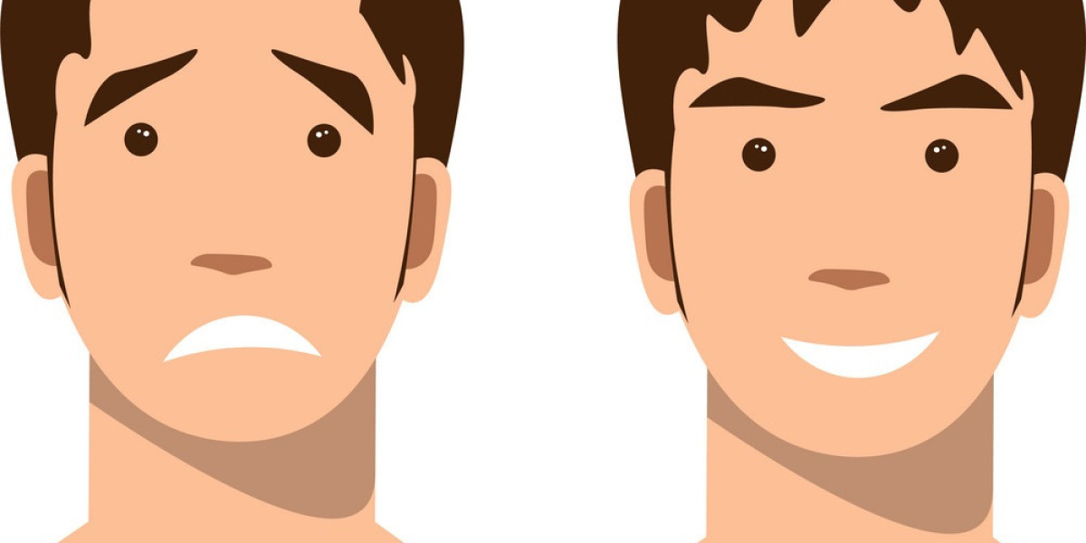 A Young Man’s Guide to Hair Loss and Transplants