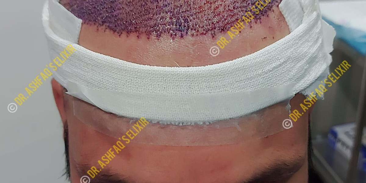 Scar Repair After FUE Hair Transplant