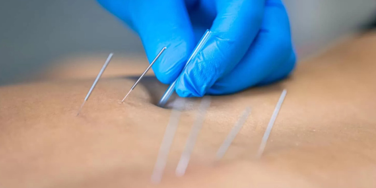 Discover the Power of Dry Needles at Dynasty Clinic