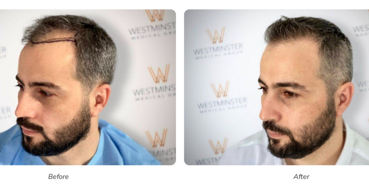 Hair Transplant UK – Your Guide to Getting Your Hair Back